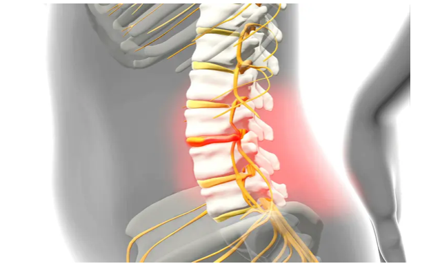 Understanding the Difference Between a Herniated Disc and a Spinal Cord Injury