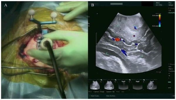 OpenIGTLink: Open source Development Library for building Medical Image-Guided Therapy (IGT) Solutions