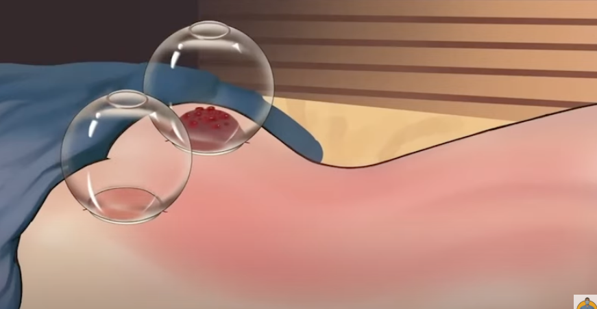 Why Wet Cupping Isn’t for Everyone: A Doctor’s Perspective